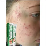 Anti-Acne Cream Effectively Removes Skin Nodules Pustules Cysts Papules Blackheads Men And Women Acne Skin Care Essence Cream