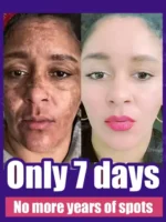 Powerful Cream Fast Skin Lightening Solve Melasma Dark Spots Suitable for all ages