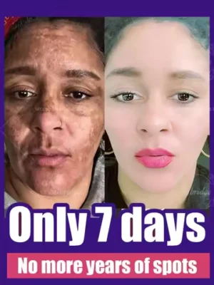 Powerful Cream Fast Skin Lightening Solve Melasma Dark Spots Suitable for all ages